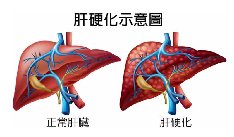 什么是肝硬化？肝硬化是如何慢慢發(fā)生的！