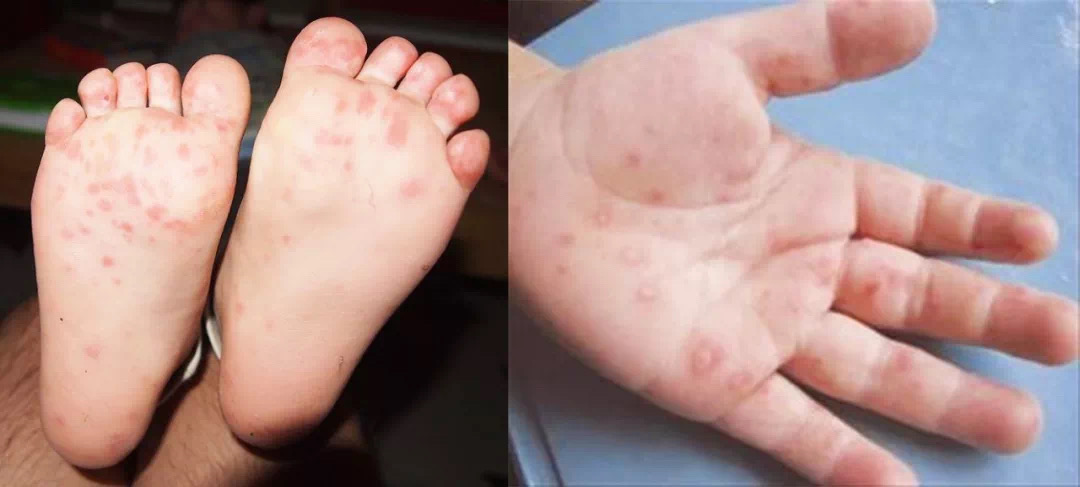 手足口病高發(fā)，傳染性強(qiáng)，可不是普通的感冒發(fā)熱！出現(xiàn)以下癥狀要警惕