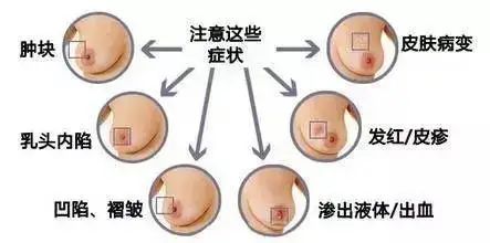 什么是乳腺癌？為什么會(huì)患乳腺癌？乳腺癌的早期癥狀有哪些？一文讀懂！