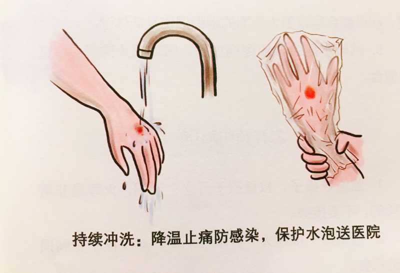 兒童意外燒傷燙傷，如何處理？牢記五個字