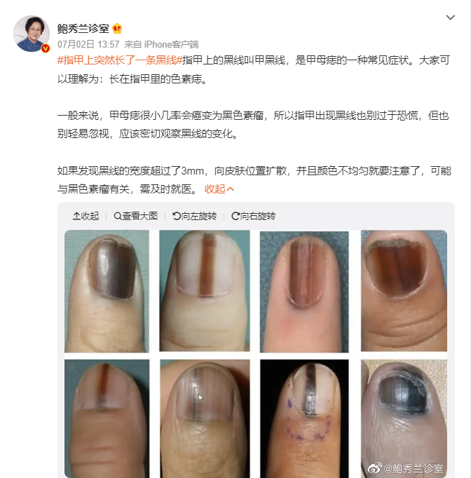 指甲長(zhǎng)黑線(xiàn)、杵狀指、手指結(jié)節(jié)腫塊，三種手指的特異變化，要警惕是癌癥信號(hào)！